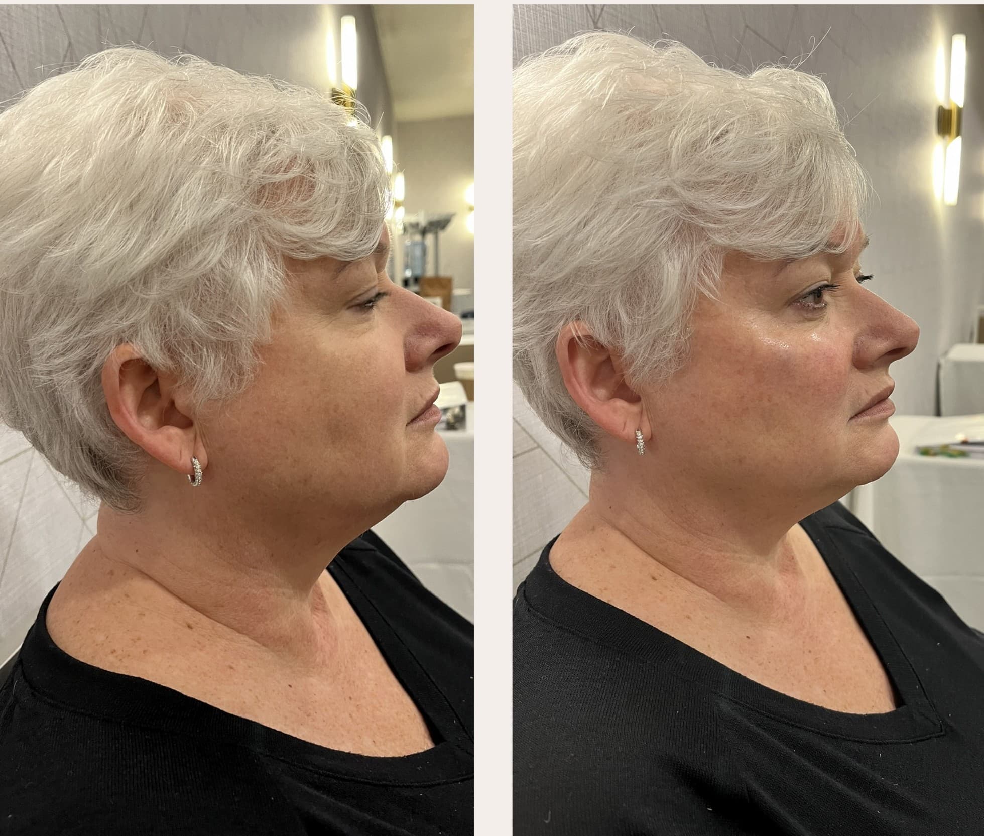 Before and after dermal filler treatment at SEA Medical Wellness