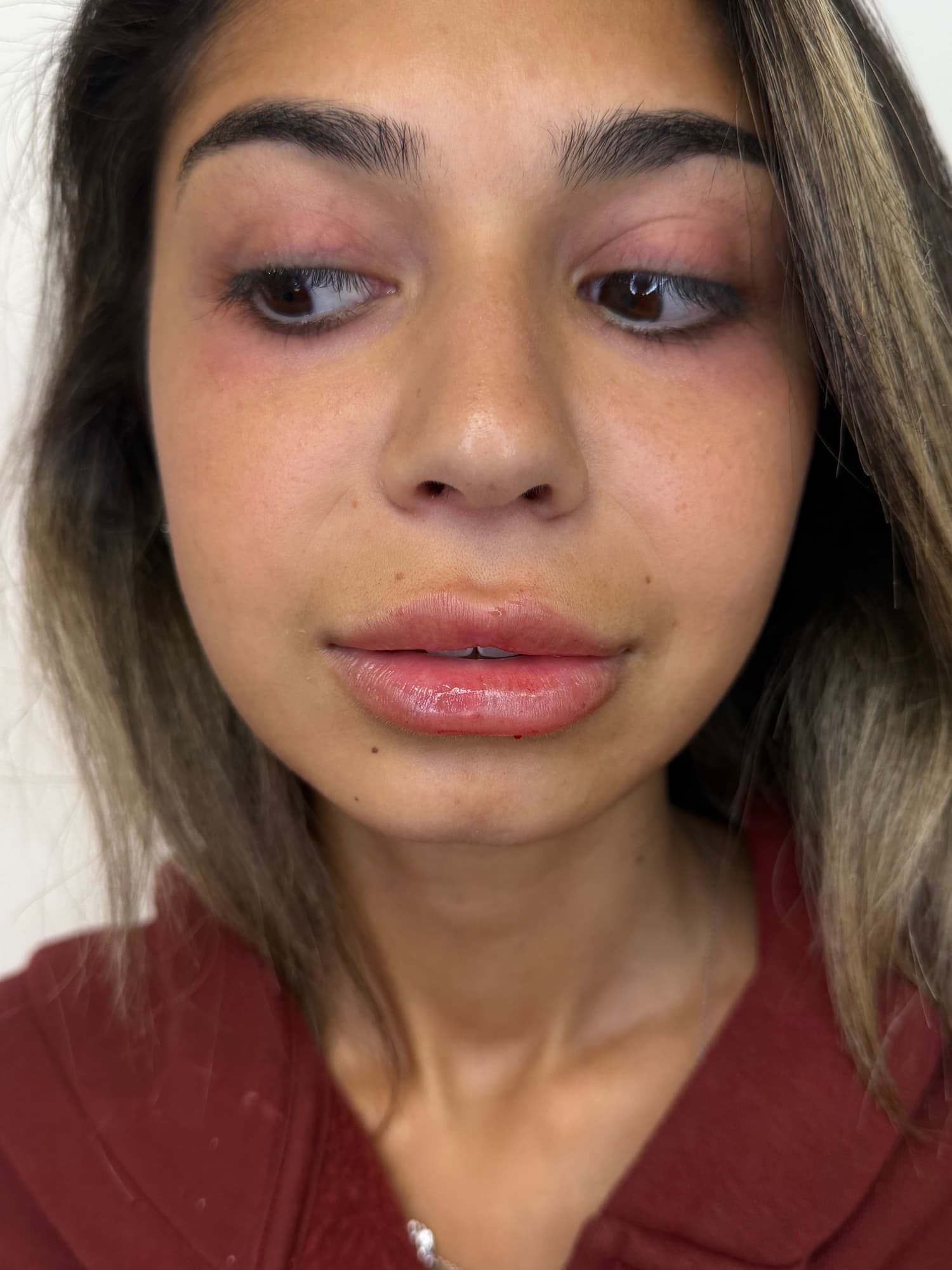 Lip filler treatment result at SEA Medical Wellness