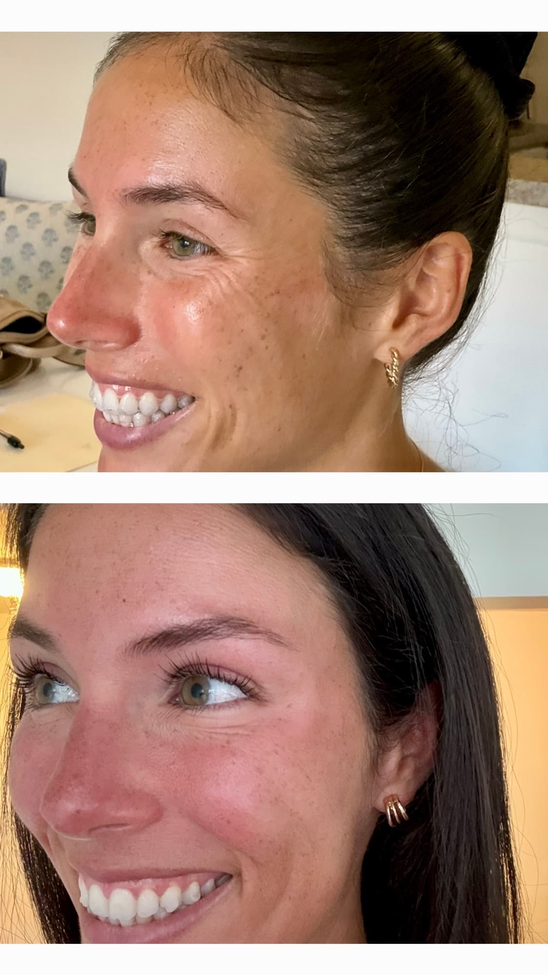 Before and after wrinkle relaxer treatment