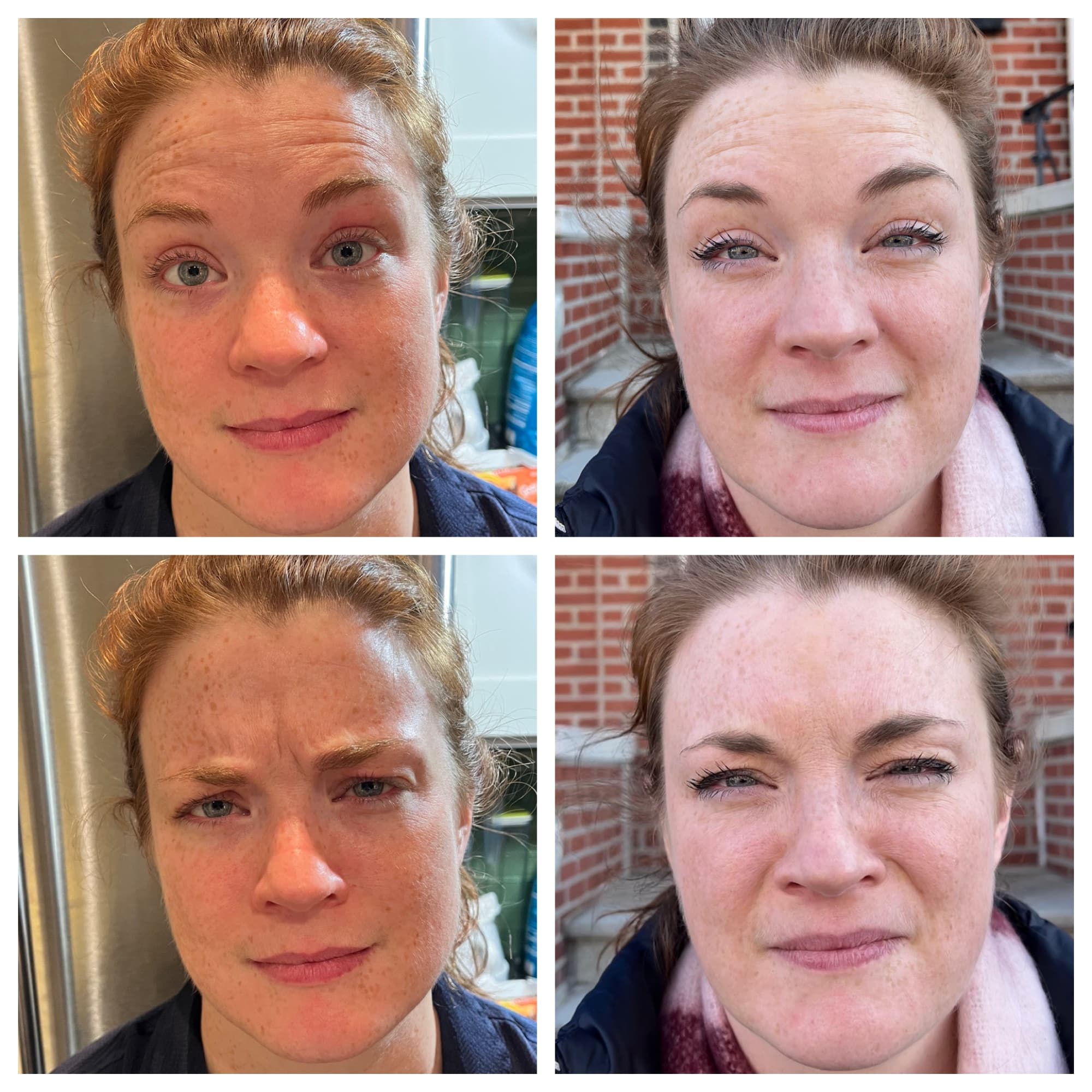 Before and after wrinkle relaxer treatment, forehead lines