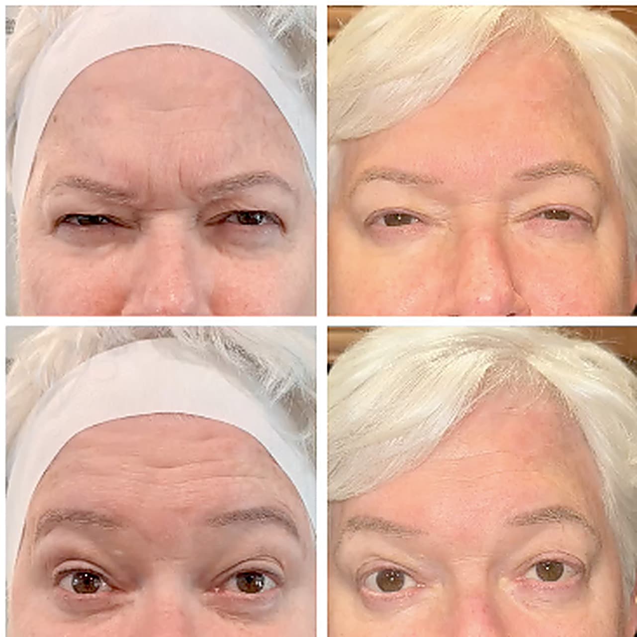 Before and after wrinkle relaxer treatment at SEA Medical Wellness