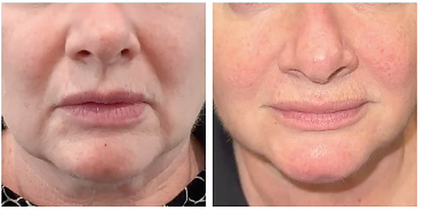 Dermal filler treatment results at SEA Medical Wellness