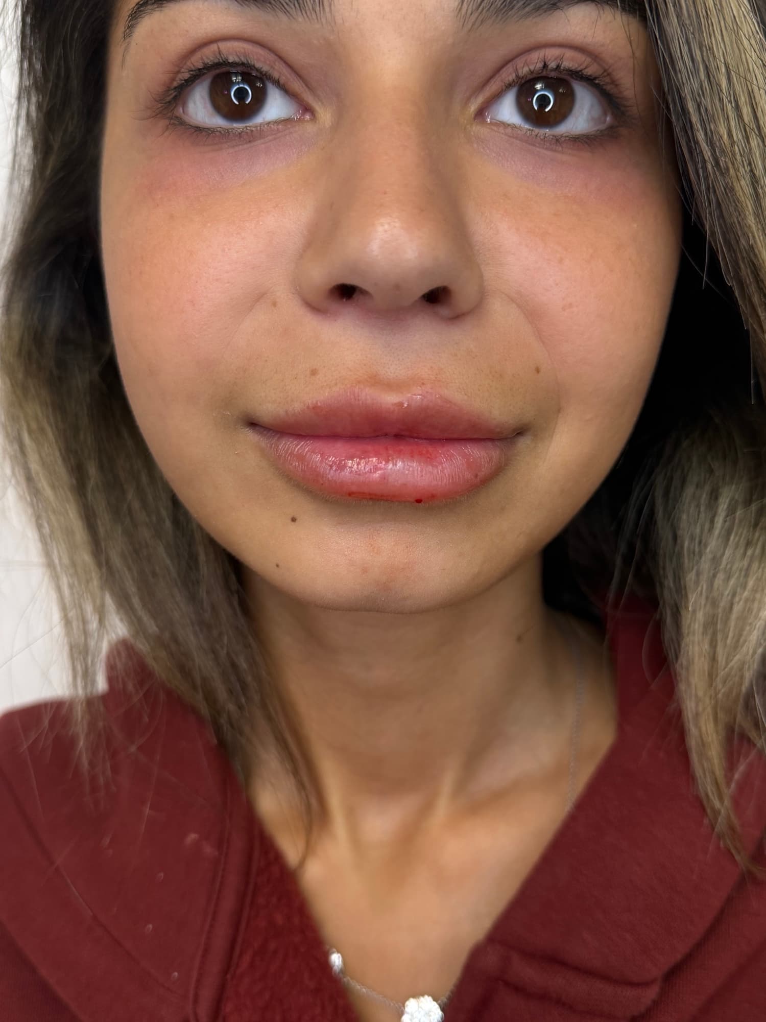 Lip filler treatment at SEA Medical Wellness