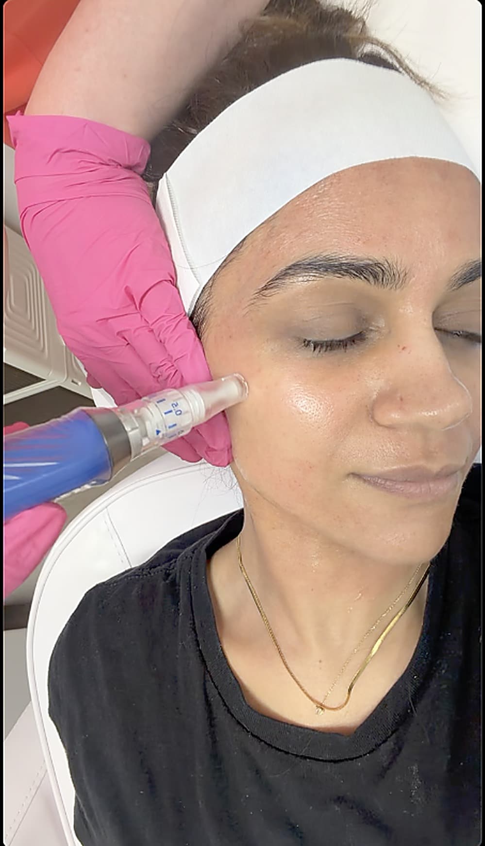 SkinPen microneedling treatment in progress at SEA Medical Wellness