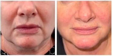 Before and after dermal filler treatment
