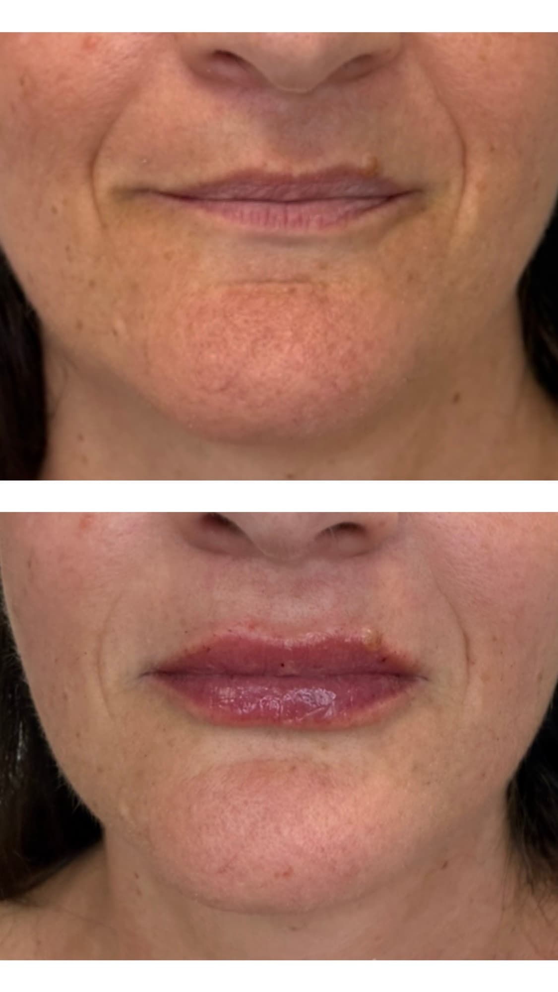 Before and after lip filler treatment