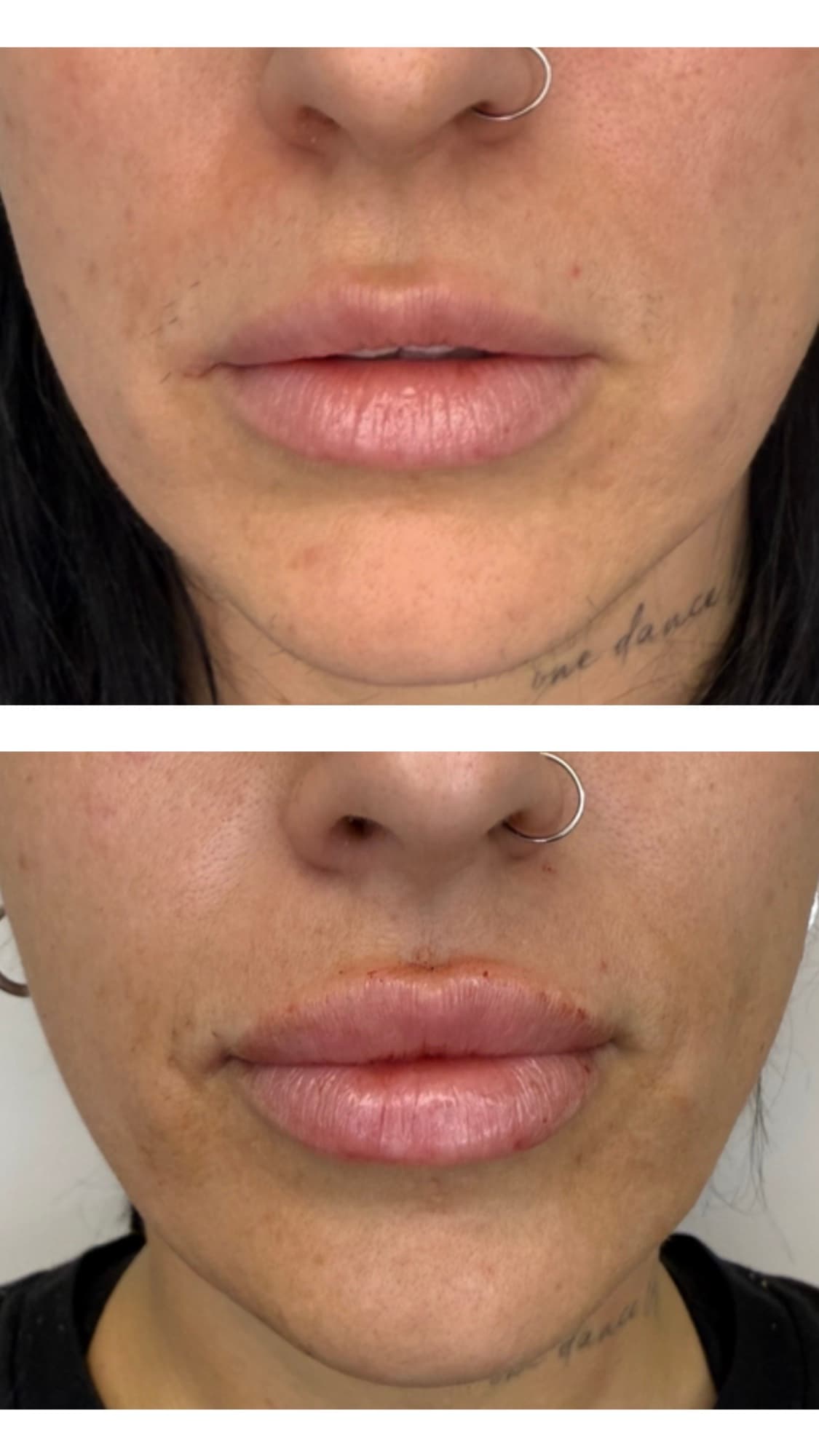 Before and after lip filler treatment