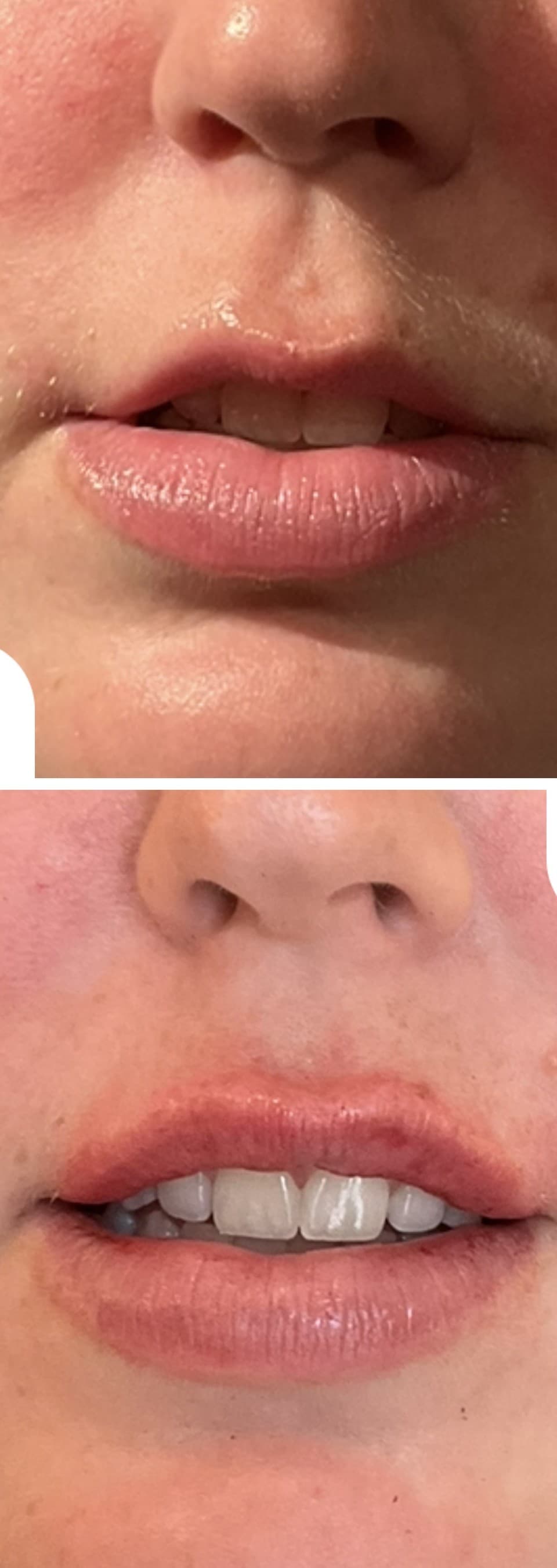 Before and after lip filler treatment
