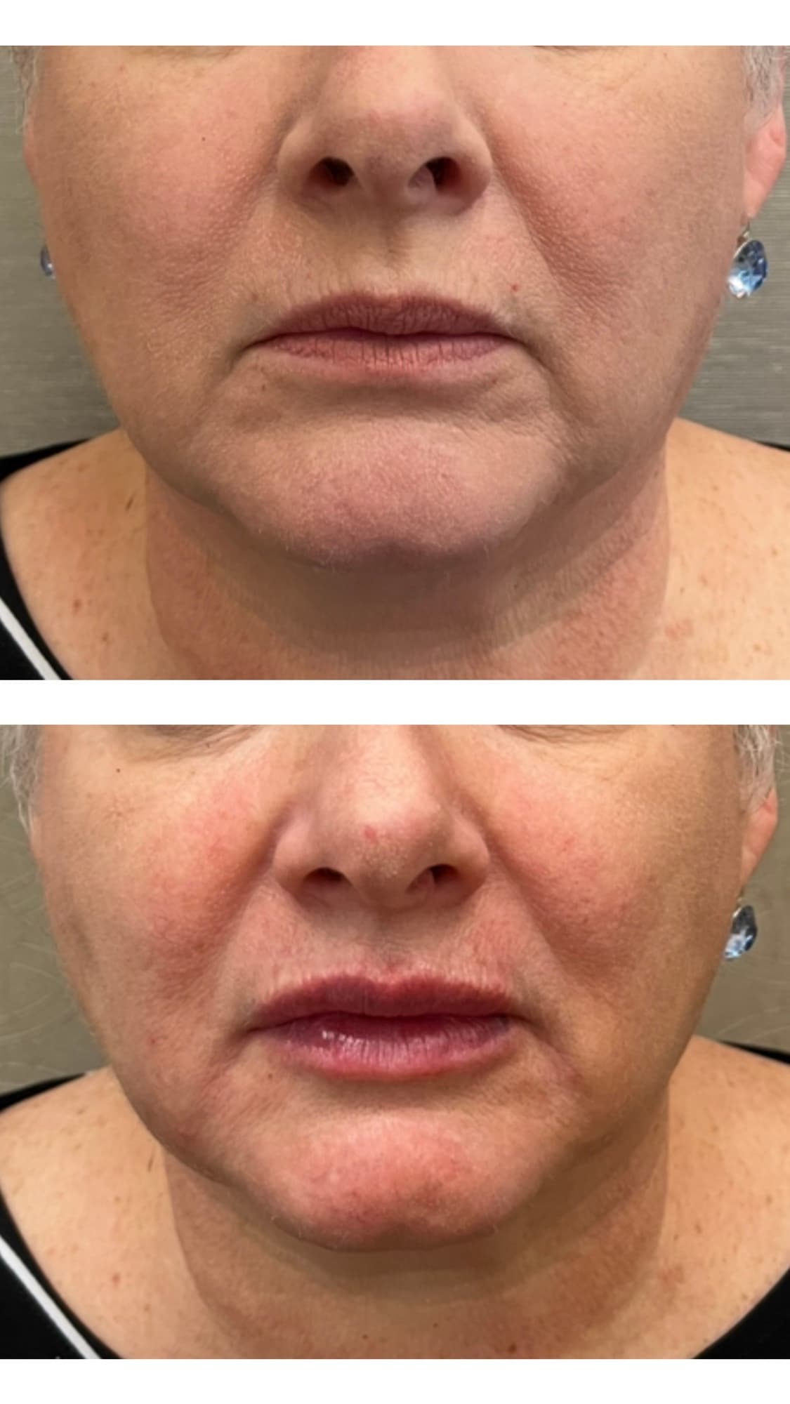 Before and after lip filler treatment