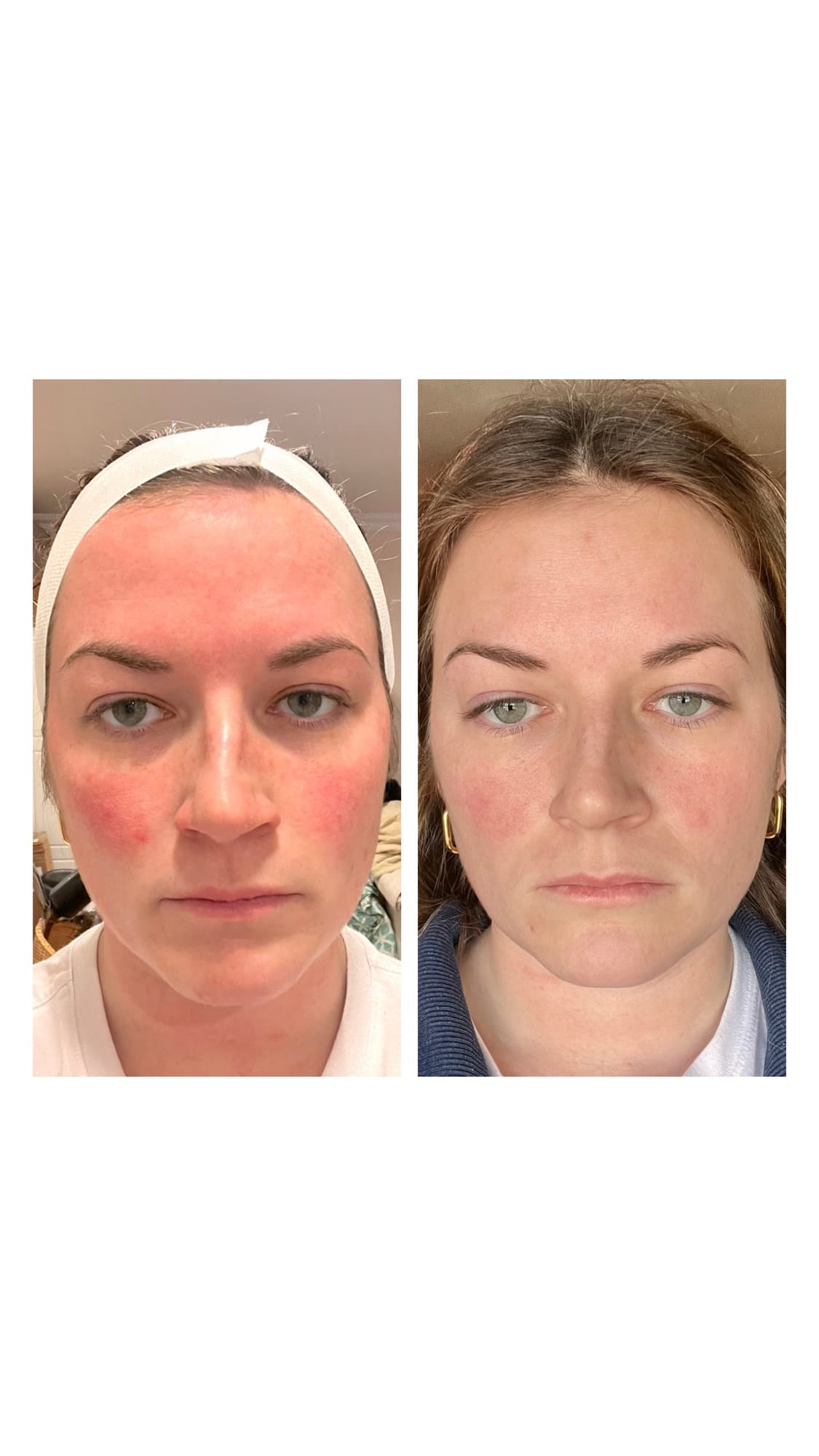 Before and after SkinPen microneedling treatment