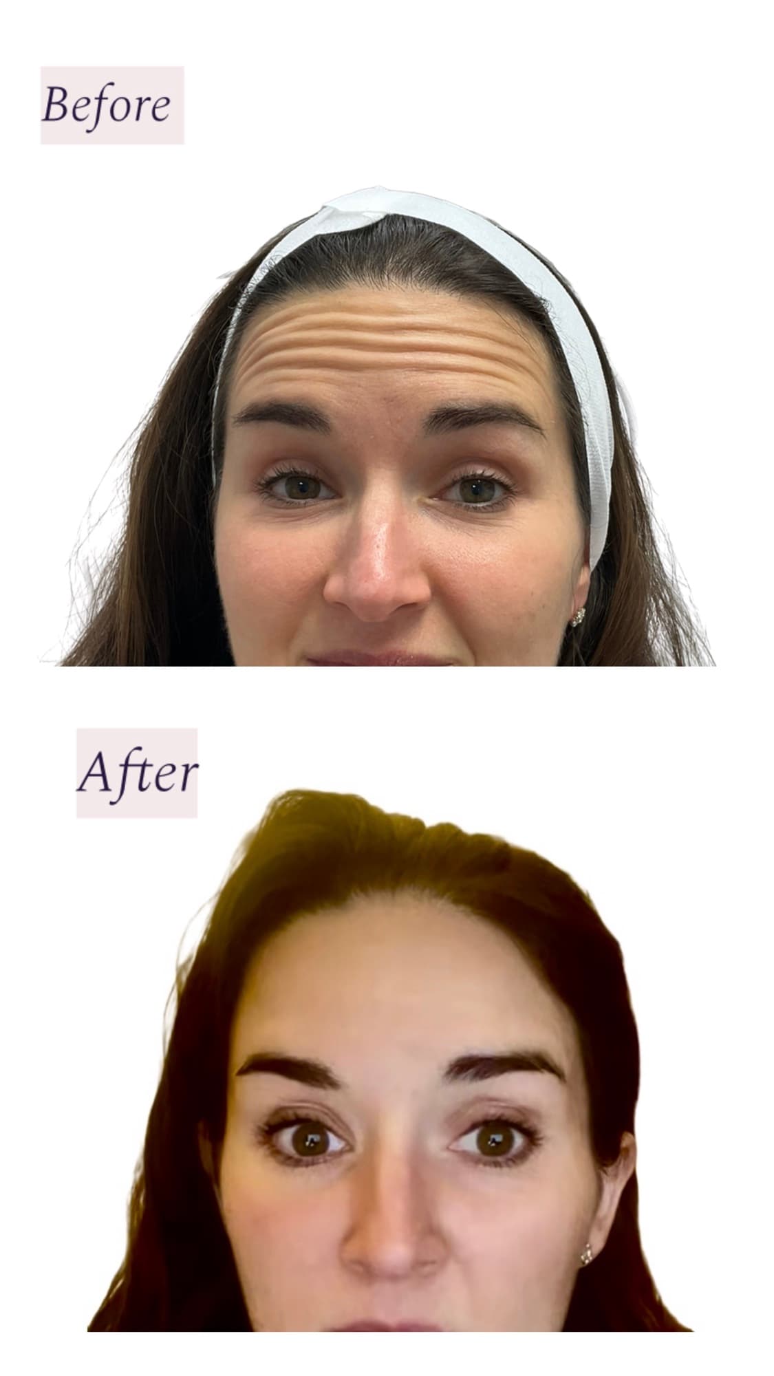 Before and after wrinkle relaxer treatment, forehead lines