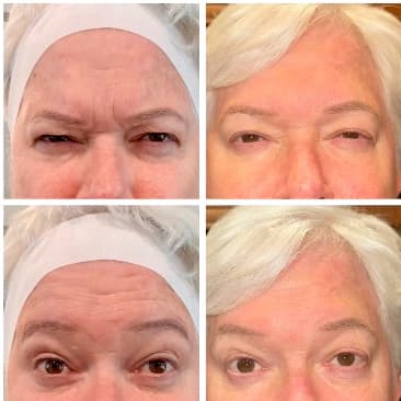 Before and after wrinkle relaxer treatment, forehead lines