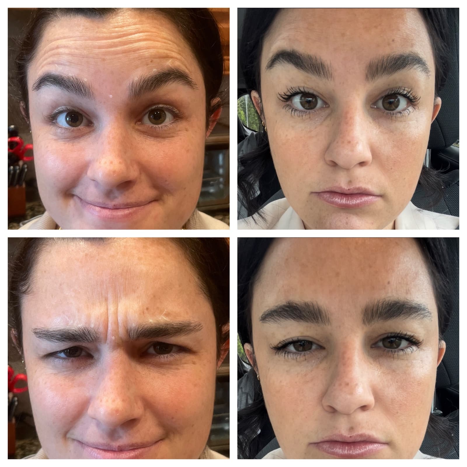 Wrinkle relaxer treatment at SEA Medical Wellness