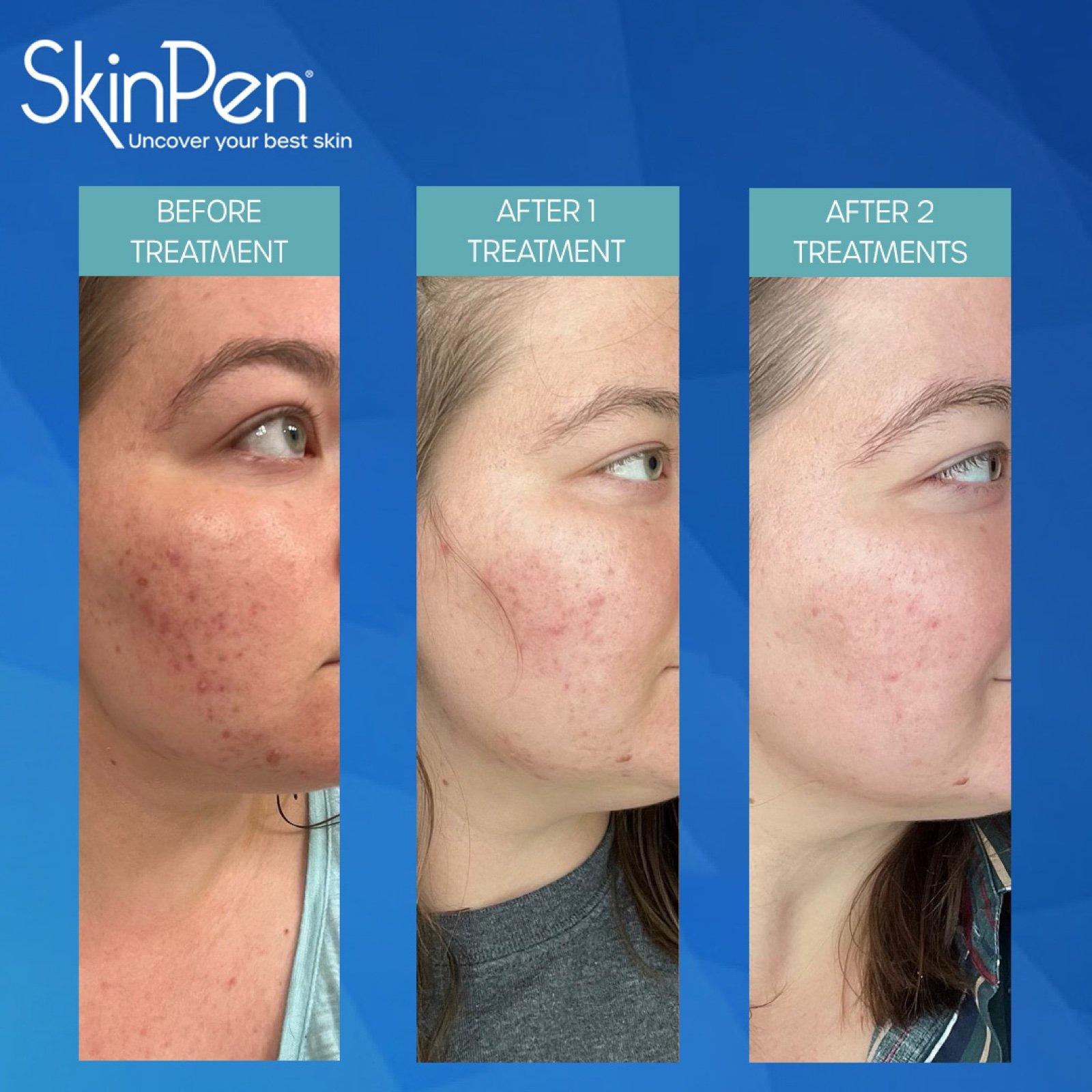 SkinPen educational graphic showing example results before treatment, after one treatment, and after two treatments